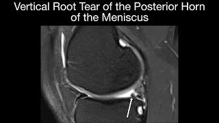 Vertical Root Tear of Posterior Horn of the Meniscus and Meniscal Ossicle