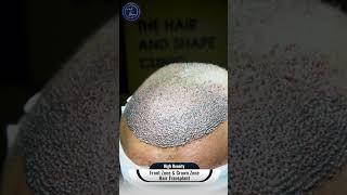 From planning to perfection! Watch the journey of rediscovering confidence through a hair transplant