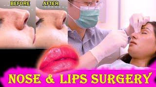 NOSE JOB AND LIPS LIFT | C-LU POKHREL | KK GOLDIE | #VLOG_36