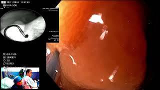 ERCP Procedure Using a Gastroscope