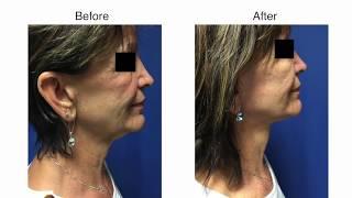 Facelift by Dr Damian Marucci