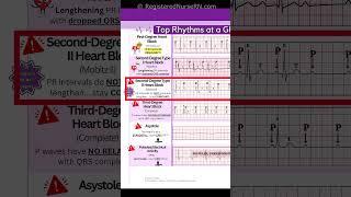 ECG (EKG) Rhythms to Know: Sinus Rhythms, Sinus Tachycardia, Heart blocks, etc.