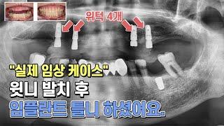 임플란트틀니 실제 후기 사례 -  22년차 전문의 설명