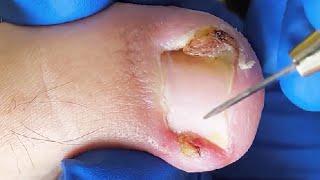 The Truth About Ingrown Toenails: Advice from a Podiatrist