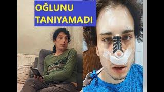 BURUN AMELİYATI OLDU ANNESİ ŞOK GEÇİRDİ