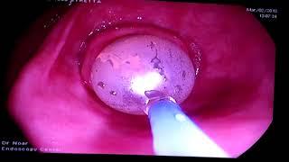 3CPM | Balloon Dilation Demonstration