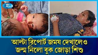 বুক জোড়া লাগানো যমজ শিশুর জন্ম পাবনায় | Twins | Pabna | Rtv News