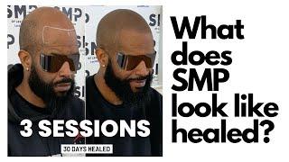 Healed Scalp Micropigmentation #SMP on Black Skin