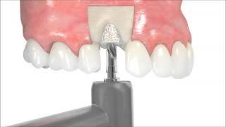 the botiss maxgraft bonering technique by Dr. Bernd Giesenhagen