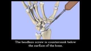 Scaphoid Fracture Screw Fixation