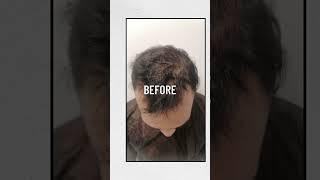 Amazing Hair Transplant!