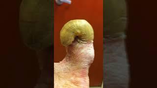 TOENAIL FUNGUS BEYOND ABILITY TO TREAT  #shorts #fungus