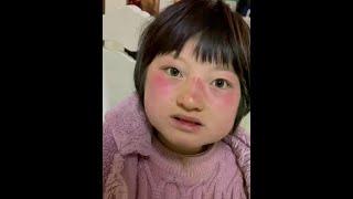 高烧退后，脸上都变成这样，不知道什么原因，都说是过敏#特殊儿童 #流感高发期 #天使综合症希希