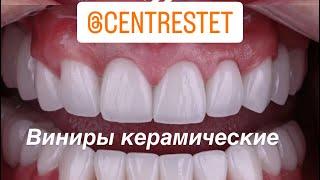 Керамические виниры без обточки.#винирыназубы #стоматология