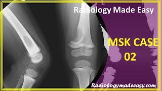 FRCR Radiology MSK Case 02: A 2 yrs old boy presented with knee swelling