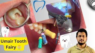 Left upper 6 with 4 canals Root canal treatment #dental #dentistry #umairtoothfairy ​@Umairazeem8553