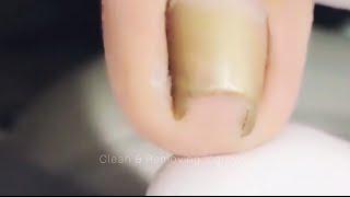 Cut Big Dirty Ingrown Toenail 485 剪大脏向内生长脚趾甲 #health #shorts