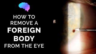 How to Remove a Foreign Body from the Eye | Eye Injury | OSCE Guide | UKMLA | CPSA | PLAB 2