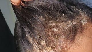 Dandruff Removal - Scalp Scratching