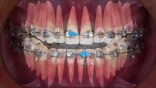 Clinical tip: Midline Correction with Intermaxillary Elastics｜【Chris Chang Ortho】CC451