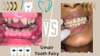 Porclain crowns makes you smile #umairtoothfairy #dentist #viral #umairazeem @Umairazeem8553