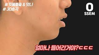 돌출입교정 하면 잇몸도 들어가나요?? 덧니+돌출입 (교정전후,30초각)