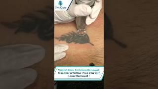 Tattoo Removal With Laser | Skinqure