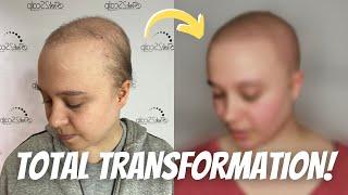 Total Transformation: Alopecia to SMP | Client Testimonial | Ink2Scalp SMP Studios