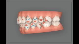 Invisalign clincheck. Treatment simulation to corect an open bite for adult patient