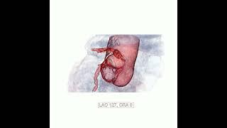 aortic insufficiency