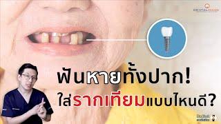 ฟันหายทั้งปาก!...ใส่รากเทียมแบบไหนดี?!? | หมอโชคมีคำตอบ Dentalimage