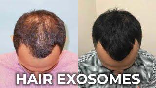 Thick & Healthy Hair with Exosomes Therapy: Before and After results