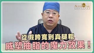 大腿抽脂 的秘密武器:  從假跨寬到真腿粗，威塑 抽脂 展現實力!