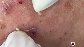 Big Cystic Acne Blackheads Extraction Blackheads & Milia, Whiteheads Removal Pimple Popping