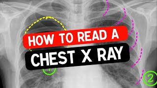 How to read a chest x ray ? Simplified & systemic approach