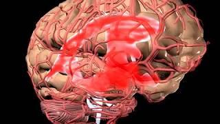 How Do Cerebral Aneurysms Form Animation - Cerebral Aneurysm Pathophysiology Video