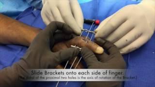 DigiFix® Surgical Technique - Dynamic