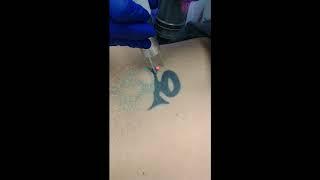 Back Laser Tattoo Removal at Skin Deep Laser Services Burke VA