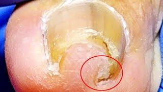 Extremely Curled Toenails, Deeply Ingrown Nail Beds【Xue Yidao】