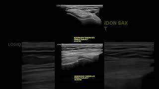 #ultrasound Guided Interventions: Healthy quadriceps tendon