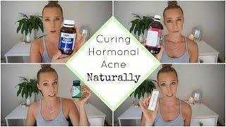 Hormonal Acne Update | PCOS | How I Cured My Acne