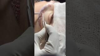 Eyebrow Transplant with Sapphire FUE Method in India