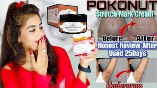 Honest Review Of POKONUT Strech Mark Cream After 25Days Used | Reduce Pregnancy Marks #pokonut