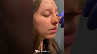 Rhinoplasty Reveal