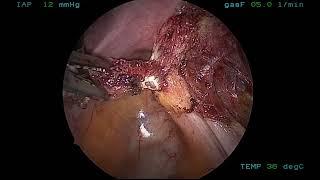 MiniLap® Percutaneous System - Endometriosis with Alligator Grasper