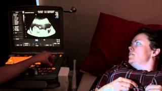 Nuchal Translucency Scan - First Trimester