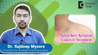 Black Warts on Face & Back|Removal of SEBORRHEIC KERATOSIS #skin  -Dr.Rajdeep Mysore|Doctors' Circle