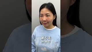 眼袋內開+蘋果肌補脂案例分享｜晶華美醫診所、晶心美醫集團、整形外科鄭穎