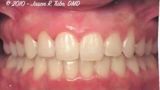 Invisalign - Before and After - Dr. Jason Tubo - Northbridge Dentist