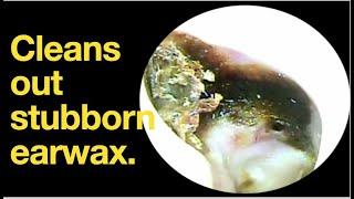 Cleans out stubborn earwax. |ear wax removal | ear cleaning | ASMR | relaxation | relax